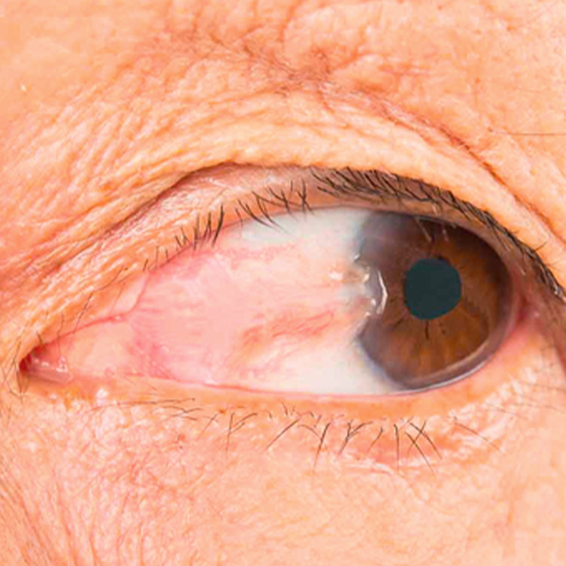 Córnea y pterigión