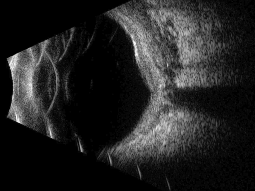 Ultrasonido ocular