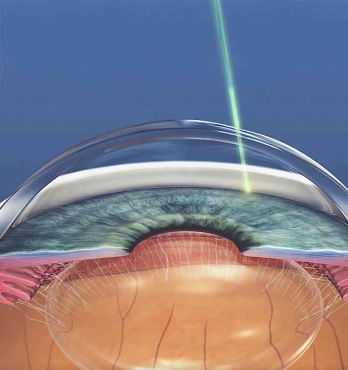 Cirugía oftalmológica en quirófano